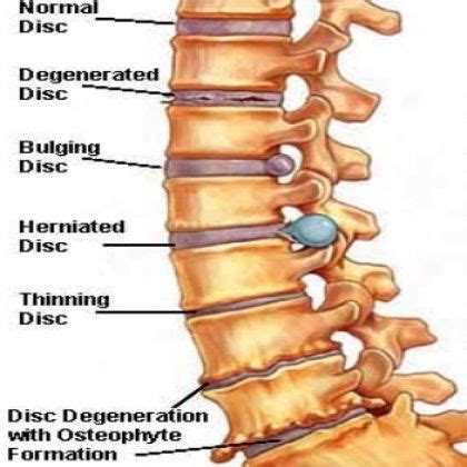 Symptoms Of Spine Arthritis | Good to Know. | Pinterest