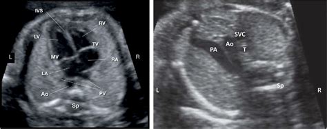 Ultrasound images of the fetal heart views used to screen for cardiac ...