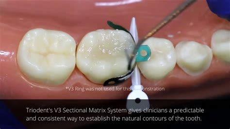 Amalgam Vs. Composite Amalgam Composite Decision - bandacruise