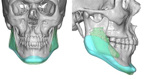 Plastic Surgery Case Study Custom Jawline Implant Replacement For