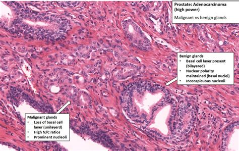 Prostate Prostatic Carcinoma NUS Pathweb NUS Pathweb