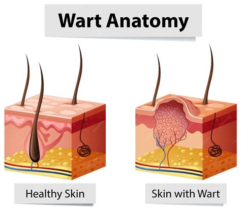 how can you tell a wart is dying 6