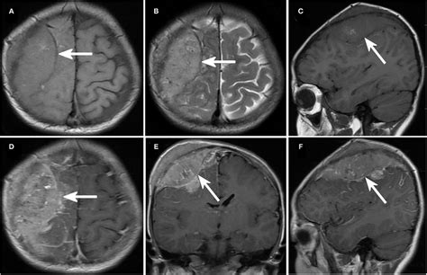 Imaging Of Neuroblastoma With Intracranial Metastases AC Axial