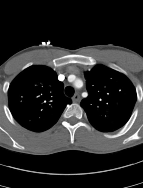 Arterial switch procedure (Radiopaedia 31607-32493 Axial) - NC Commons