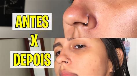 Granuloma Piercing Como Tirar