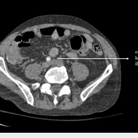 Ct Of The Abdomen And Pelvis With Contrast Demonstrating Occlusion Of