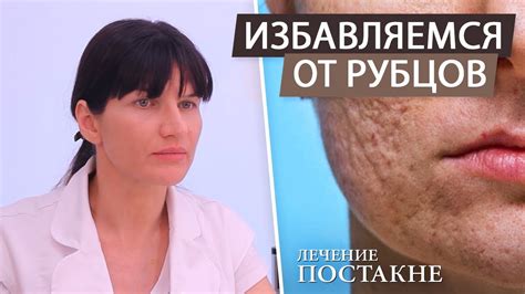 Как удалить шрамы и рубцы на лице после акне (постакне). Лазерная ...