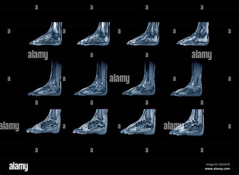 Charcot Arthropathy Coloured Magnetic Resonance Imaging Mri Scans Of