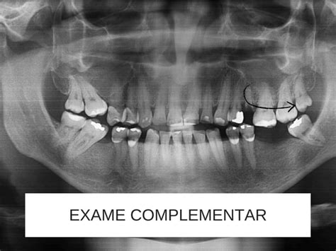 Planejamento Cir Rgico Exodontia De Resto Radicular Do Elemento