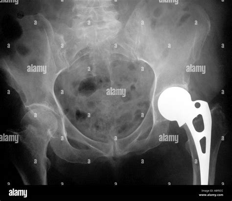 Hemiarthroplasty hi-res stock photography and images - Alamy