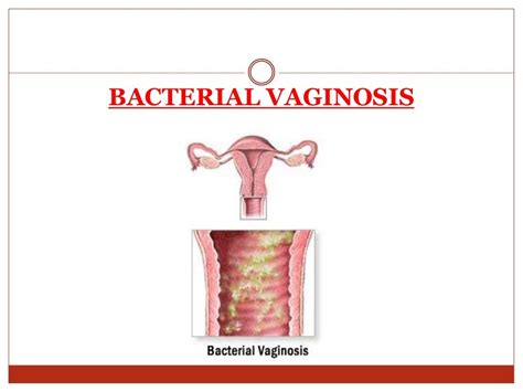 Infections During Pregnancy