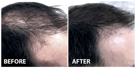 The Trusted Prp Hair Treatment For Men In Malaysia Premier4him