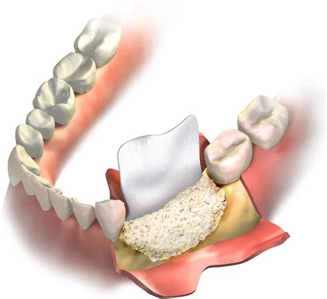 Dental Bone Graft Healing Stages How Long Does It Heal