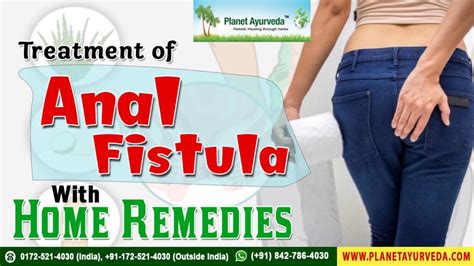 Treatment Of Anal Fistula Anal Fissure With Home Remedies Without