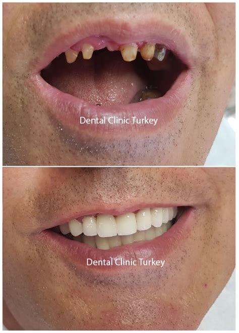 Single Tooth Implant - Single Tooth Replacement | Dental Clinic Turkey