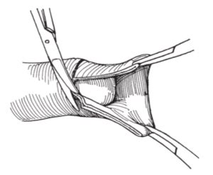 сколько стоит обрезание крайней плоти в Украине - Здоровье мира