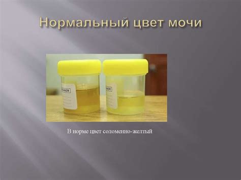 Нормальная моча: что значит нормальный цвет мочи у взрослых и детей