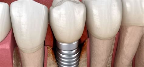 Treatment Of Peri Implantitis Wimpole Street Dental Clinic