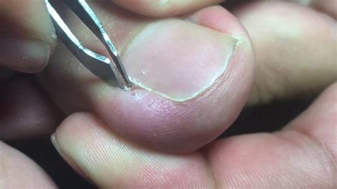 Ingrown Toenail Removal Youtube