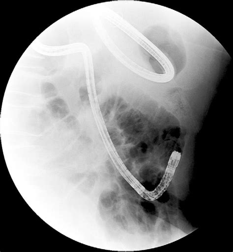 Figure 3 From Gallstone Ileus Successfully Treated With Endoscopic