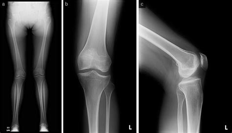 The Full Length Standing Radiograph A Shows Genu Valgum