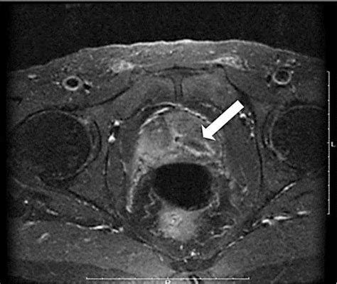 Figure 1 From Metastatic Prostatic Ductal Adenocarcinoma Successfully