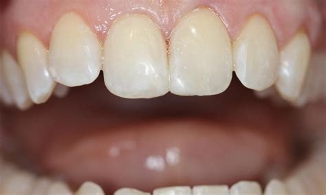 Resin bonding to repair fractured front teeth Before & After Photos ...