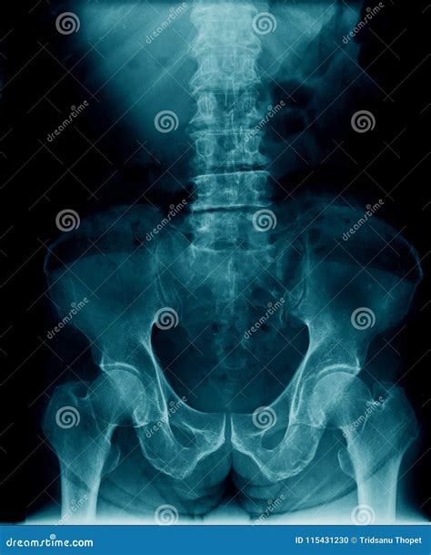 Lumbar Compression Fracture Royalty-Free Stock Photography