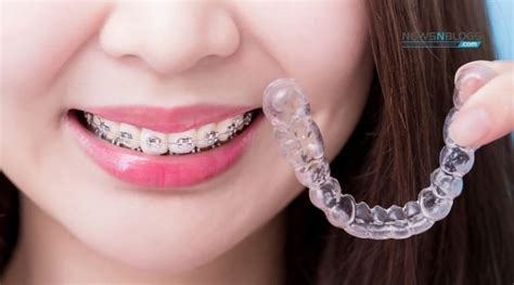 Metal Vs Ceramic Braces Which Is Better