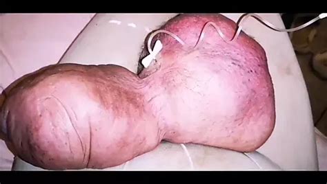 Another Extreme Filling Up With Glucose Gay Pump Porn Feat Monster Meat By Faphouse Xhamster