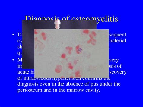 PPT - Osteomyelitis PowerPoint Presentation - ID:969412