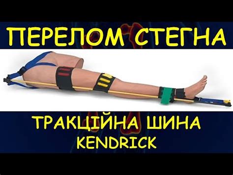 ПЕРЕЛОМ СТЕГНОВОЇ КІСТКИ: ТРАКЦІЙНА ШИНА "KENDRICK". Особливості ...