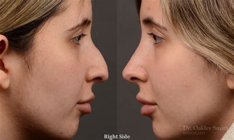 Auto Draft Toronto Rhinoplasty Surgery Nose Surgery By Dr Oakley