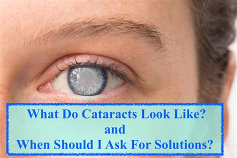 What Do Cataracts Look Like And When Should I Ask For Solutions