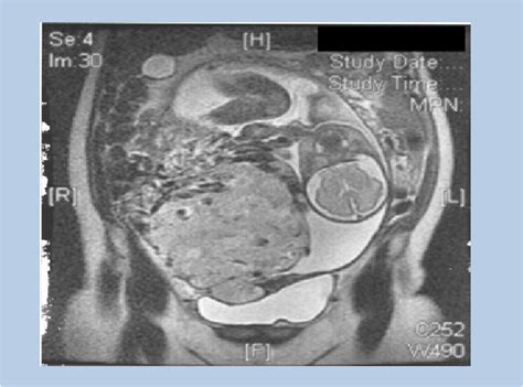 Figure 1 From Surgical Management Of Placenta Accreta A Six Year