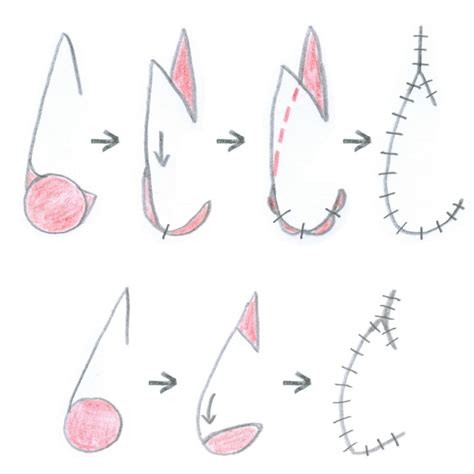 Flap Surgery