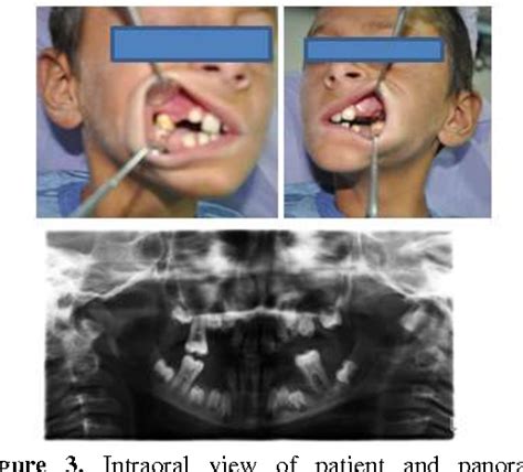 Figure 3 From Olgu Sunumu Papillon Lefevre Syndrome And Oral Findings