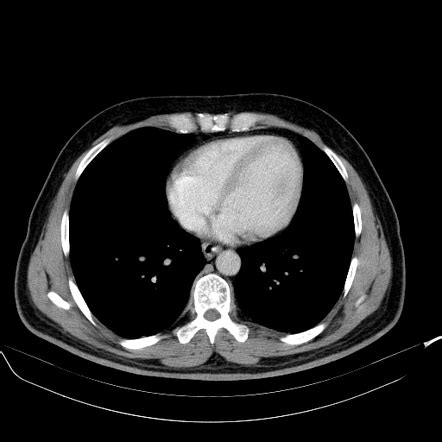 Hepatic Epithelioid Hemangioendothelioma Image Radiopaedia Org