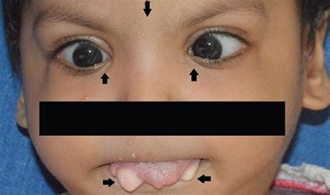 Oro Facial Digital Syndrome Type Ii With Lingual Lipomas Indian