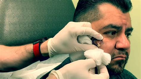 Cyst Incision And Drainage At Las Vegas Dermatology® In Nevada