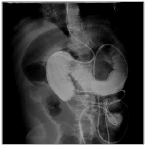 Application Of Small Intestine Decompression Combined With Oral Feeding