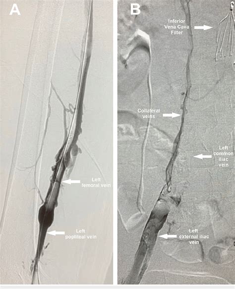 Venogram Performed After Ivc Filter Insertion Showing Extensive