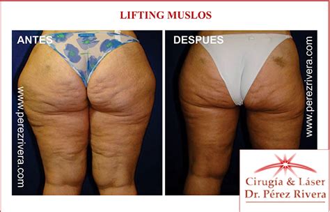 Cruroplastia Lifting Muslos Lifting Cara Interna De Muslos