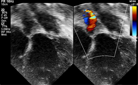 Frontiers Echocardiographic Imaging And Ventricular Mechanics In