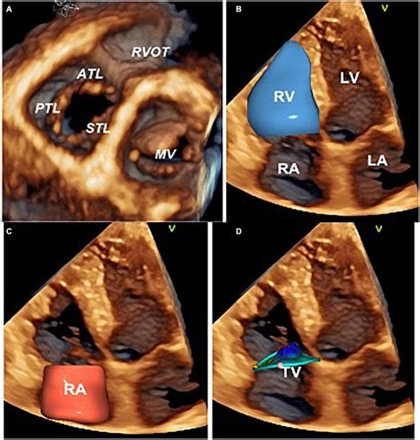 Tricuspid Valve Anatomy Echocardiography at Bruce Lohr blog