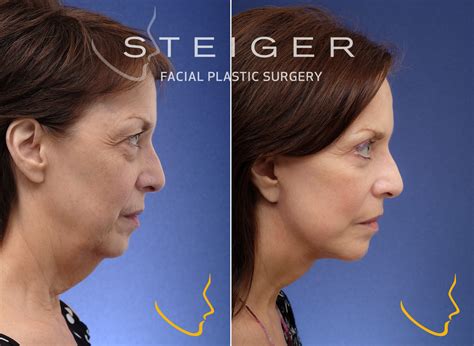 Facelift Before and After Photos | Deep Plane Facelift