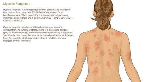 Understanding Non-Hodgkin's Lymphoma-A.D.A.M. OnDemand