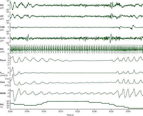 adult obstructive sleep apnoea  lancet