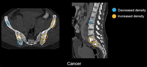 Abdominal Ct Bones • Litfl • Radiology Library