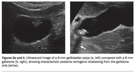 Gallbladder Polyps Ultrasound